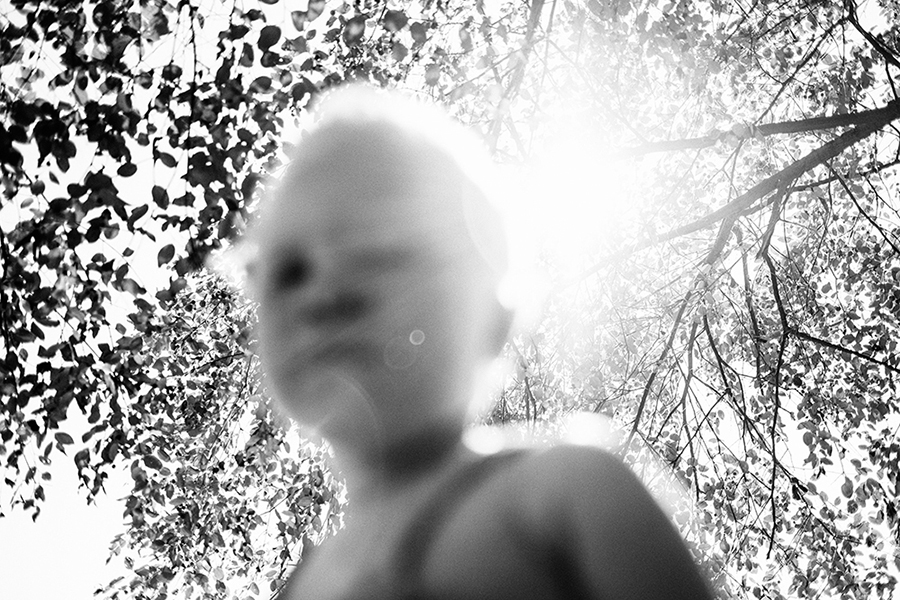 Albinos