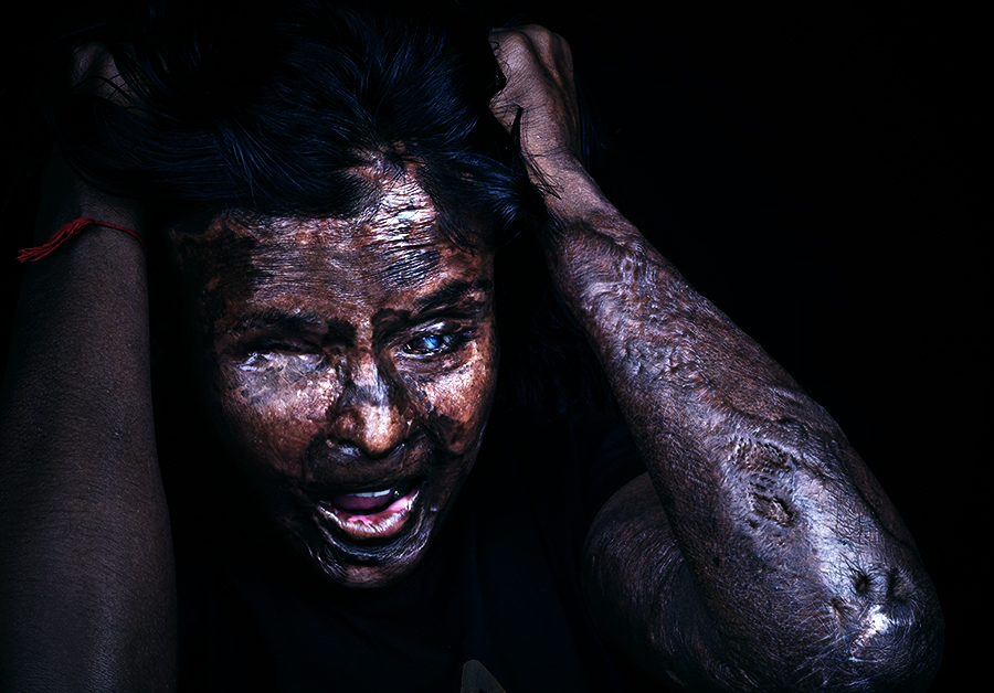 Emotional Scars - The Emotional Journey of Acid Attack Survivors !