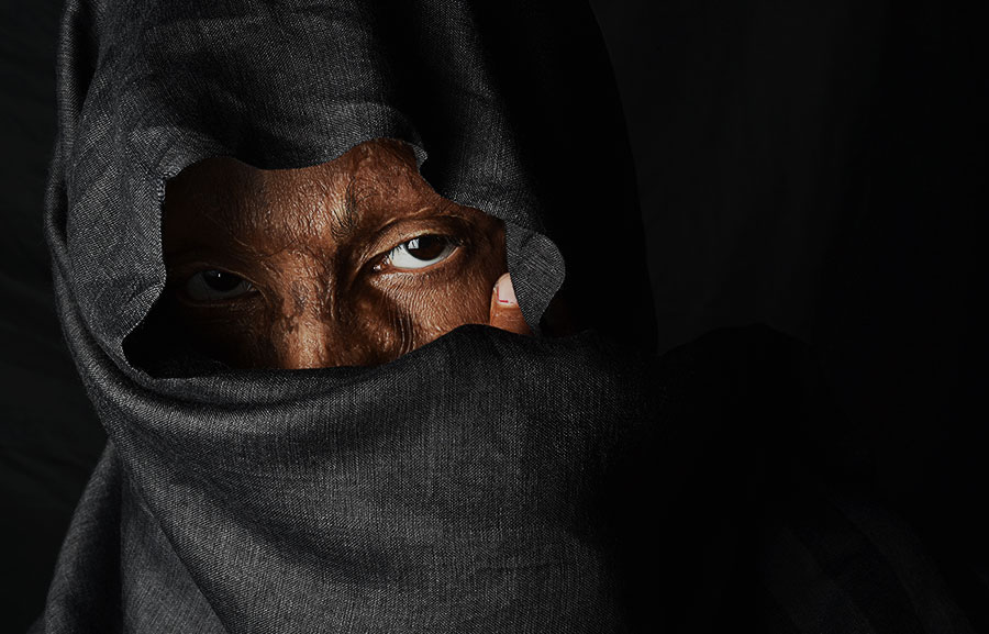 Emotional Scars - The Emotional Journey of Acid Attack Survivors !