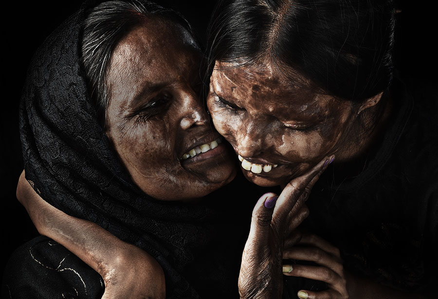 Emotional Scars - The Emotional Journey of Acid Attack Survivors !