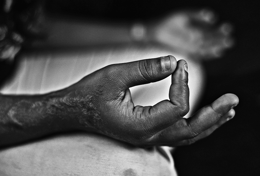 Emotional Scars - The Emotional Journey of Acid Attack Survivors !