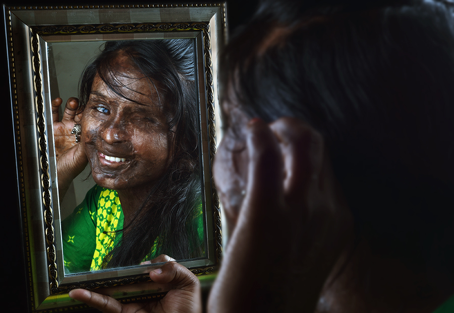 Emotional Scars - The Emotional Journey of Acid Attack Survivors !